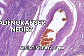 Adenokanser Nedir?
