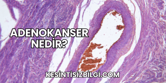 Adenokanser Nedir?