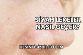 Siyah Lekeler Nasıl Geçer?